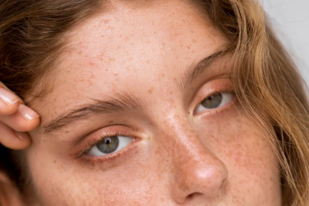 Cara Mengatasi Freckles Akibat Paparan Sinar Matahari