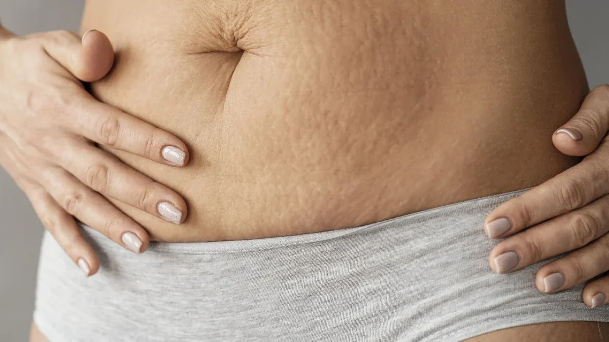 Muncul Garis Stretch Mark di Beberapa bagian Tubuh? Ketahui Apa Saja Penyebabnya (ilustrasi: Freepik)