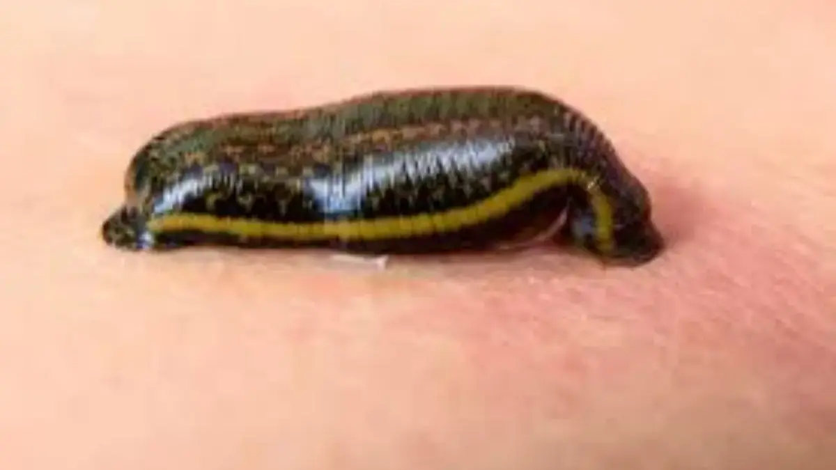 Terapi Lintah: Pengobatan Alternatif, Apakah Benar Aman untuk Tubuh?